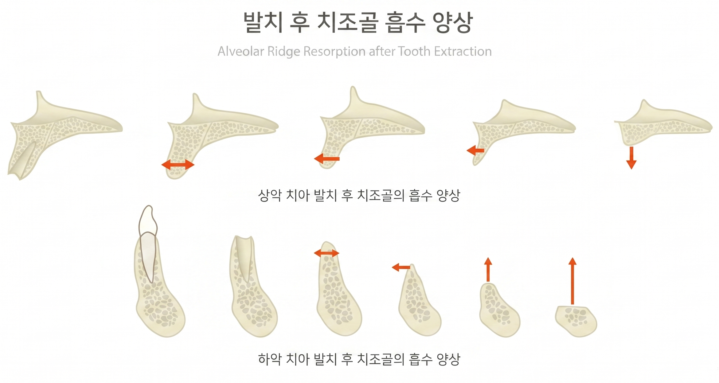 산곡동 치과 연세청천세브란스치과의원 발치 후 골흡수 단계별 변화